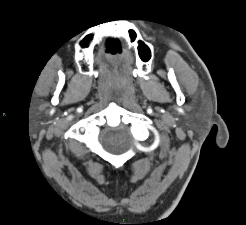 Basal ganglia hemorrhage (Radiopaedia 58763-65985 D 1).jpg