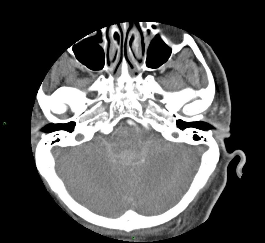 Basal ganglia hemorrhage (Radiopaedia 58763-65985 D 40).jpg