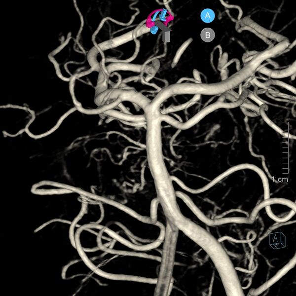 File:Basilar artery perforator aneurysm (Radiopaedia 82455-97734 3D view left VA 37).jpg