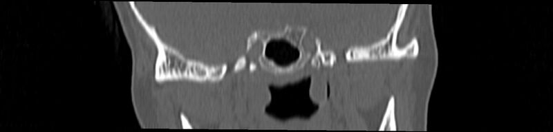 File:Basilar impression (Radiopaedia 52411-58522 Coronal bone window 44).jpg