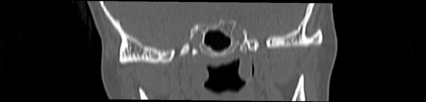 Basilar impression (Radiopaedia 52411-58522 Coronal bone window 44).jpg