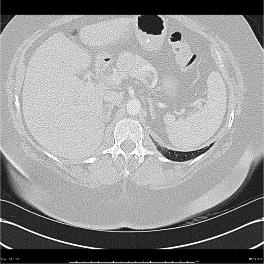Benign metastasizing leiomyoma (Radiopaedia 26803-26962 Axial lung window 54).jpg
