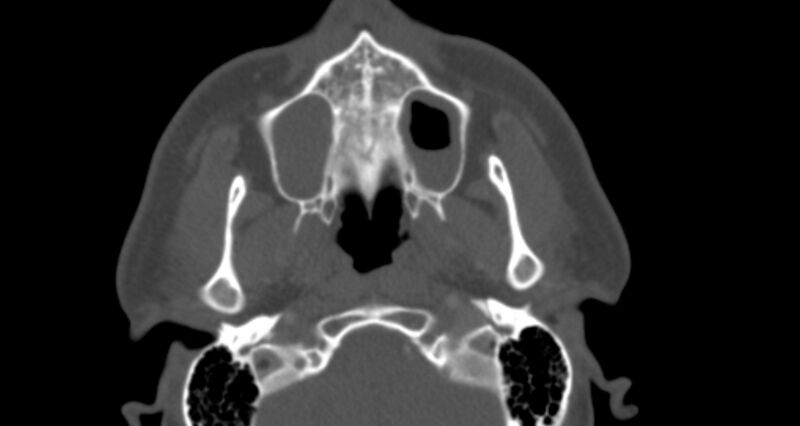 File:Benign mixed salivary tumor of the parotid gland (Radiopaedia 35261-36792 Axial bone window 12).jpg