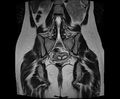 Bicornuate bicollis uterus (Radiopaedia 61626-69616 Coronal T2 23).jpg