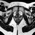 Bicornuate uterus (Radiopaedia 11104-11492 Axial T2 7).jpg