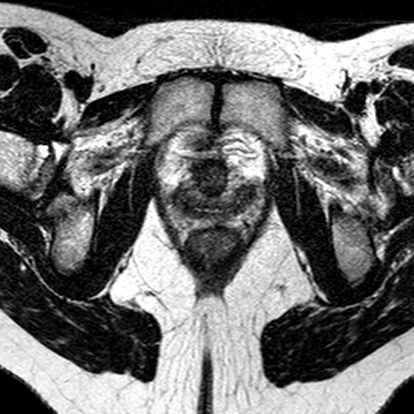 File:Bicornuate uterus (Radiopaedia 11104-11492 Axial T2 7).jpg