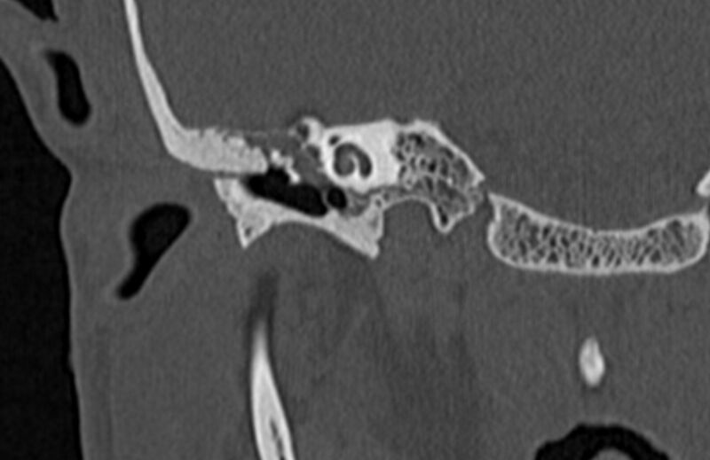 File:Bilateral cholesteatoma (Radiopaedia 54898-61172 Coronal bone window 27).jpg