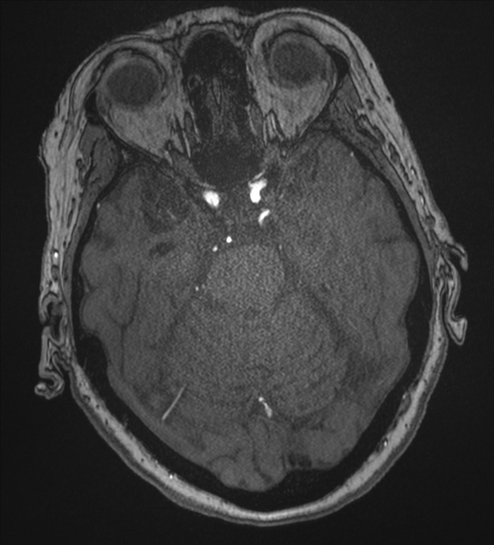 File:Bilateral fetal posterior communicating arteries (Radiopaedia 41286-44102 Axial MRA 67).png