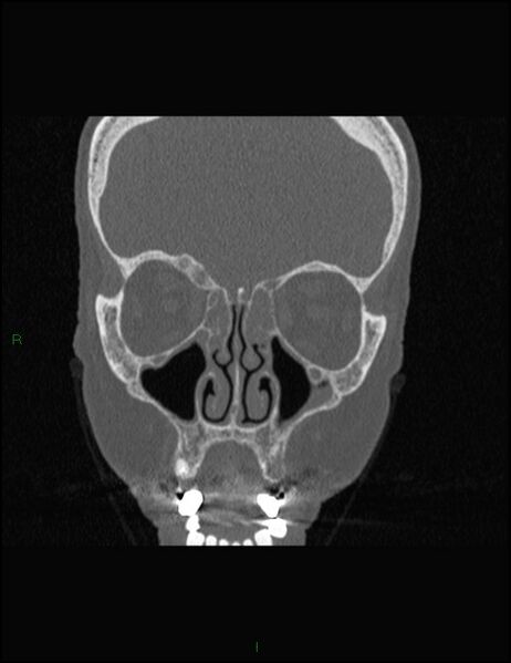 File:Bilateral frontal mucoceles (Radiopaedia 82352-96454 Coronal 126).jpg