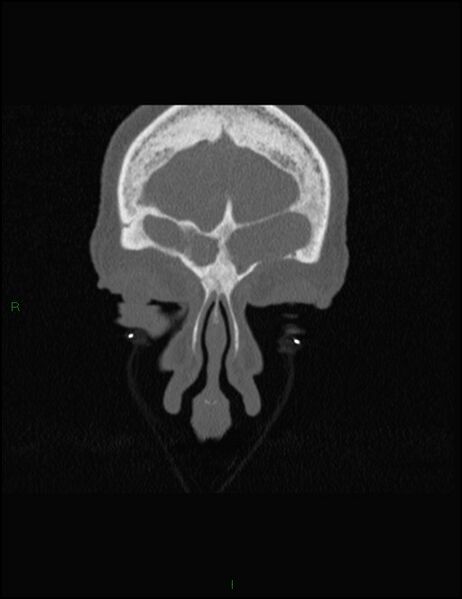 File:Bilateral frontal mucoceles (Radiopaedia 82352-96454 Coronal 58).jpg