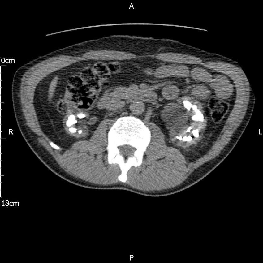 Bilateral medullary nephrocalcinosis with ureteric calculi (Radiopaedia 71269-81569 Axial non-contrast 49).jpg