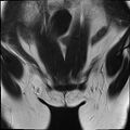 Bilateral ovarian endometriomas (Radiopaedia 87085-103347 Coronal T2 2).jpg