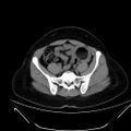 Bilateral ovarian mature cystic teratomas (Radiopaedia 79373-92457 Axial non-contrast 48).jpg