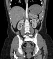 Bilateral ovarian mature cystic teratomas (Radiopaedia 79373-92457 B 52).jpg