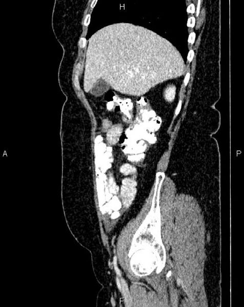 File:Bilateral ovarian serous cystadenocarcinoma (Radiopaedia 86062-101989 E 15).jpg
