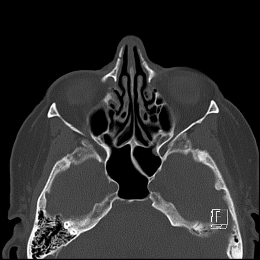 Bilateral palatine tonsilloliths on OPG and CT (Radiopaedia 75167-86247 Axial bone window 13).jpg