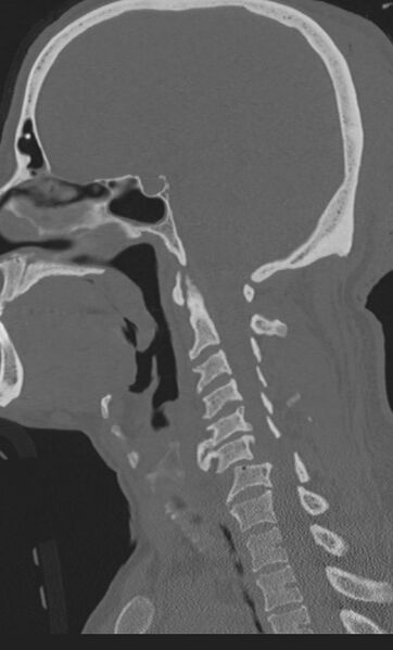 File:Bilateral perched facet joint (Radiopaedia 63149-71669 Sagittal bone window 24).jpg