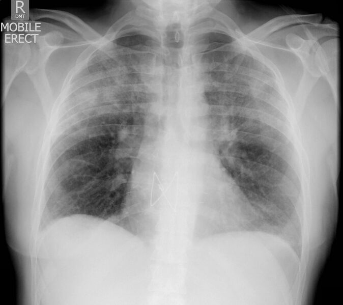 File:Bilateral pneumonia in transplant lungs (Radiopaedia 74252).jpg