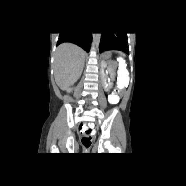 File:Bilateral renal malrotation (Radiopaedia 30901-31606 Coronal C+ delayed 1).jpg