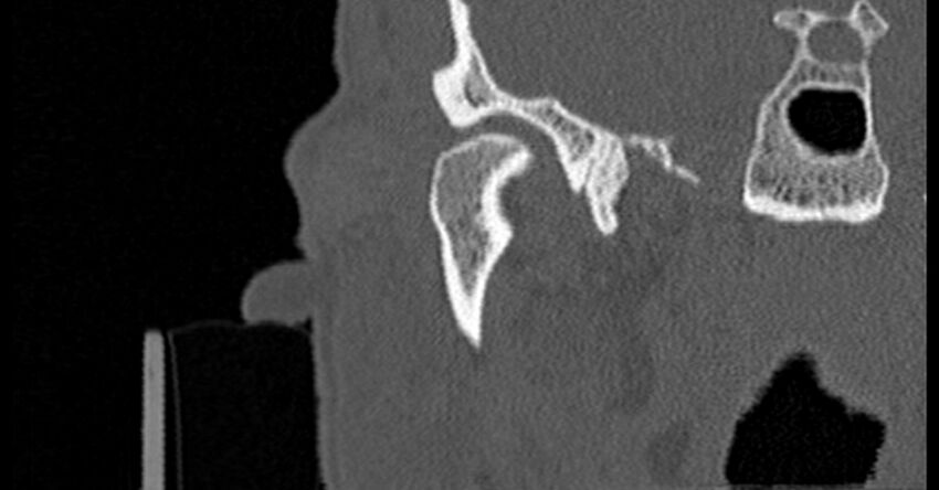 Bilateral temporal bone fractures (Radiopaedia 29482-29970 Coronal non-contrast 48).jpg