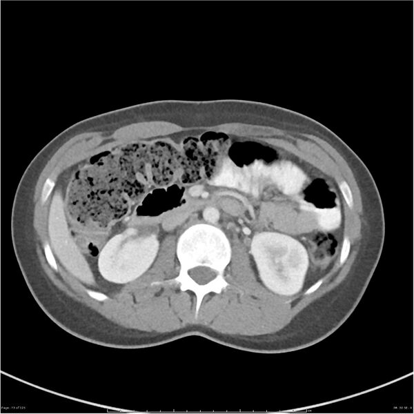 File:Bilateral ureteritis and cystitis (Radiopaedia 25340-25594 A 30).jpg