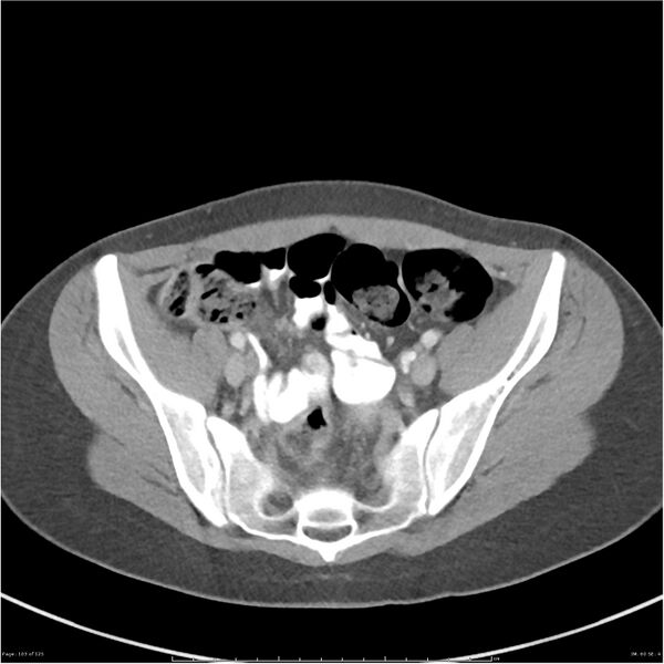 File:Bilateral ureteritis and cystitis (Radiopaedia 25340-25594 A 60).jpg
