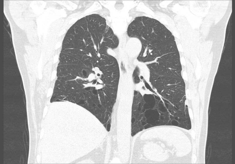 File:Birt-Hogg-Dubé syndrome (Radiopaedia 52578-58491 Coronal lung window 37).jpg