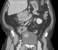 Bladder papillary urothelial carcinoma (Radiopaedia 48119-52951 C 34).png