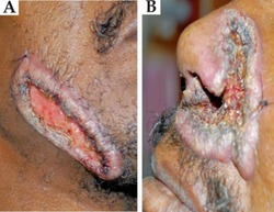 Nodular skin lesions of blastomycosis