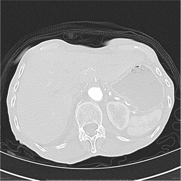 File:Boerhaave syndrome (Radiopaedia 26240-26362 Axial lung window 47).jpg