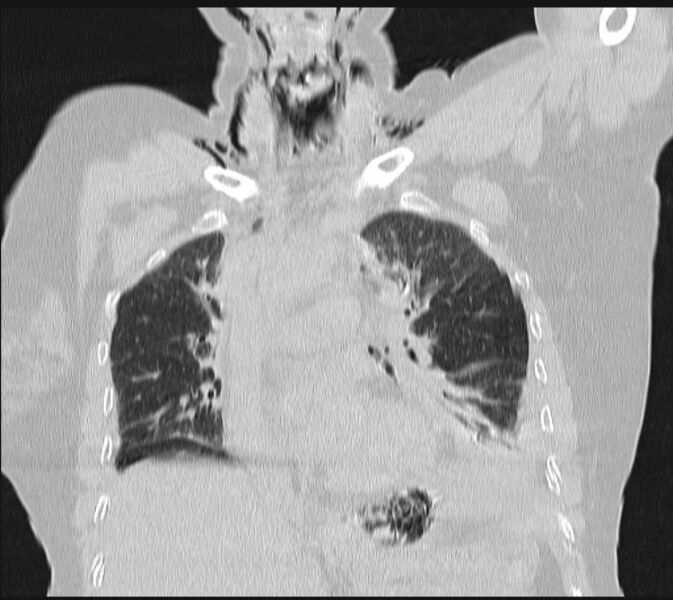 File:Boerhaave syndrome (Radiopaedia 45644-49799 Coronal lung window 29).jpg