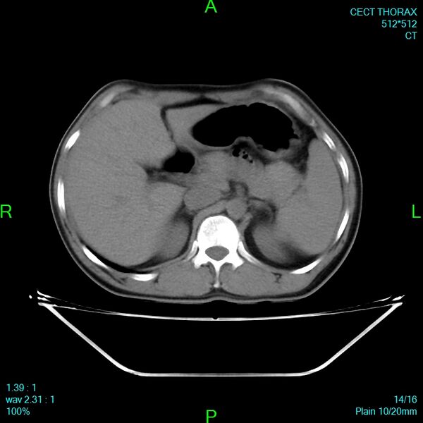 File:Bone metastases from lung carcinoma (Radiopaedia 54703-60937 Axial non-contrast 13).jpg
