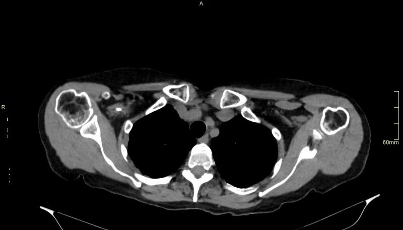 File:Brachial artery foreign body (Radiopaedia 54583-60820 Axial non-contrast 17).jpg