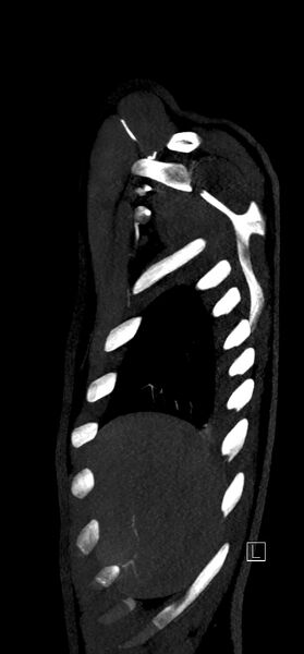 File:Brachiocephalic trunk pseudoaneurysm (Radiopaedia 70978-81191 C 12).jpg