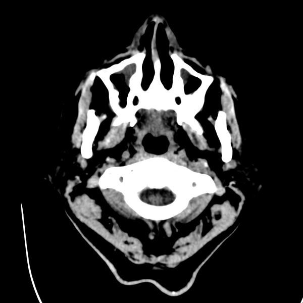 File:Brain Pantopaque remnants (Radiopaedia 78403-91048 Axial non-contrast 7).jpg