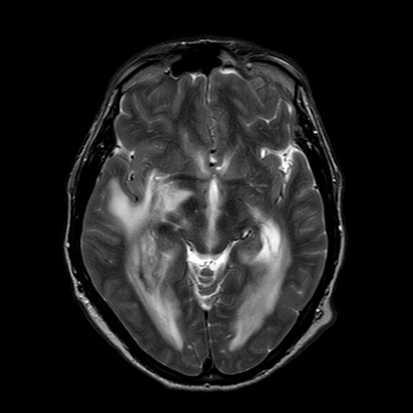 File:Brain abscess complicated by intraventricular rupture and ventriculitis (Radiopaedia 82434-96577 Axial T2 10).jpg