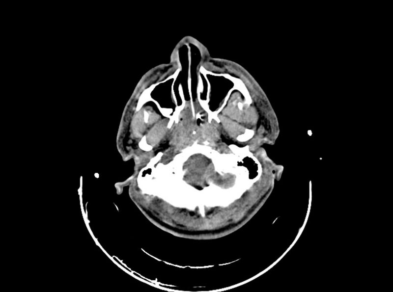 File:Brain injury by firearm projectile (Radiopaedia 82068-96087 B 47).jpg