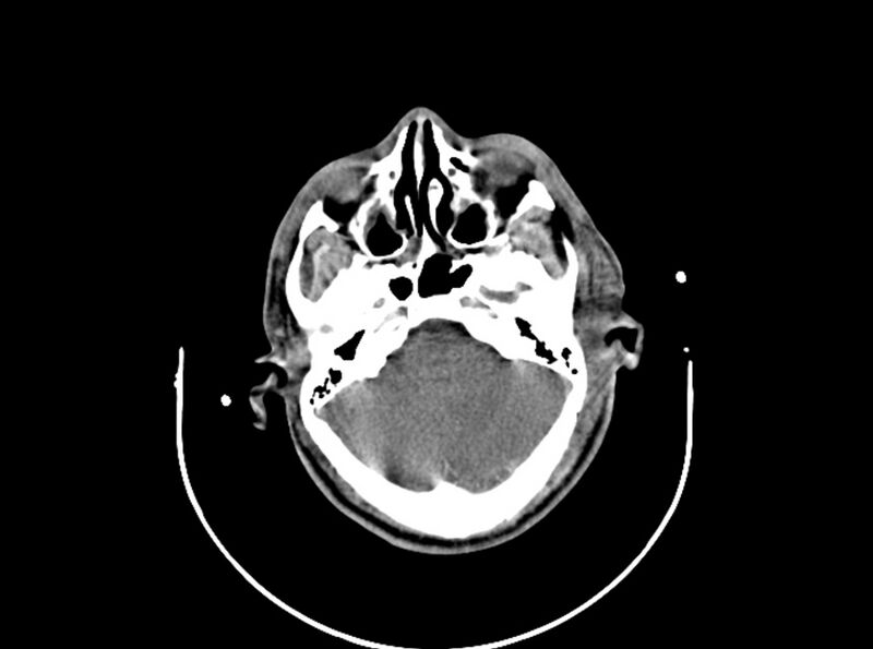 File:Brain injury by firearm projectile (Radiopaedia 82068-96087 B 64).jpg