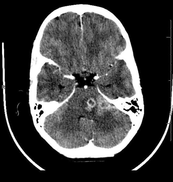 File:Brainstem glioma (Radiopaedia 6524-7838 Axial C+ delayed 1).jpg