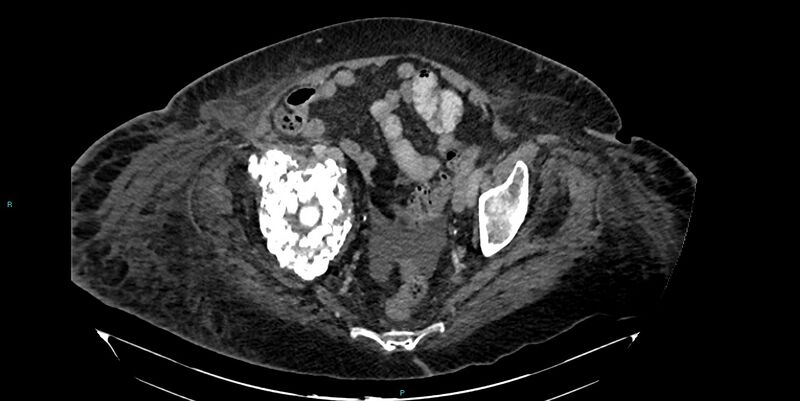 File:Breast cancer pelvic bony metastases (Radiopaedia 84470-99824 Axial bone window 47).jpg