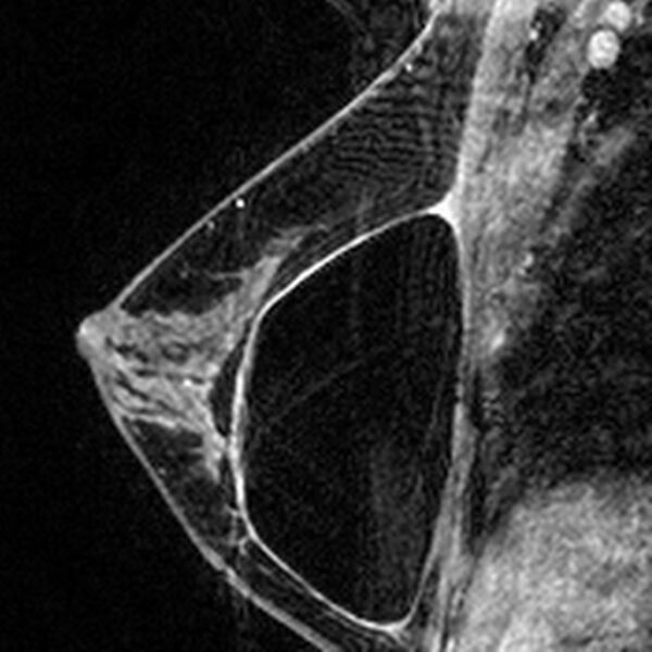 File:Breast implants - MRI (Radiopaedia 26864-27035 Sagittal T2 104).jpg