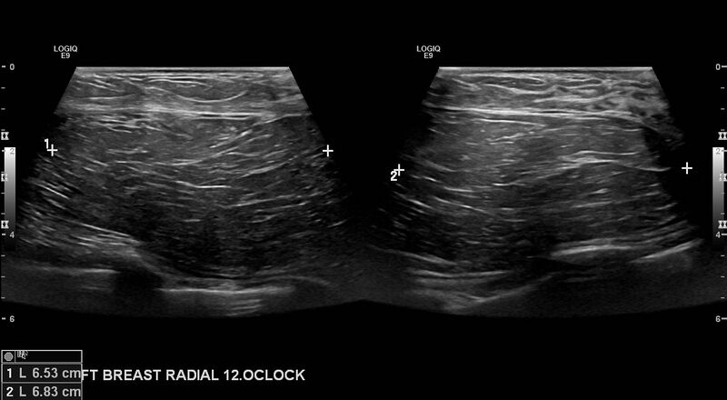 File:Breast lipoma (Radiopaedia 16321-16005 A 3).jpg