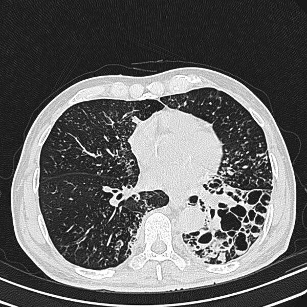 File:Bronchiectasis (Radiopaedia 22061-22059 lung window 19).jpg