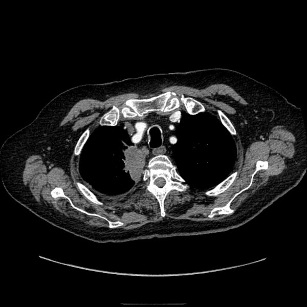 File:Bronchogenic adenocarcinoma and pulmonary embolism (Radiopaedia 9097-9806 D 14).jpg