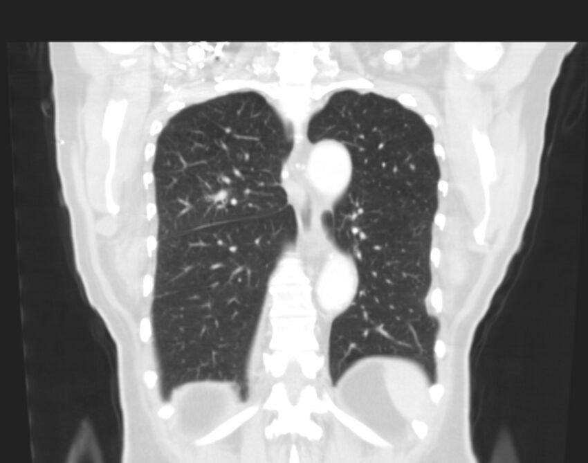 Bronchogenic carcinoma with lymphangitic spread (Radiopaedia 29002-29357 Coronal lung window 53).jpg