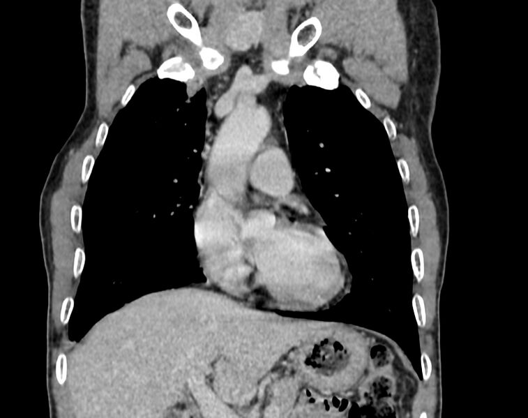 File:Bronchogenic carcinoma with superior vena cava syndrome (Radiopaedia 36497-38054 Coronal C+ delayed 11).jpg