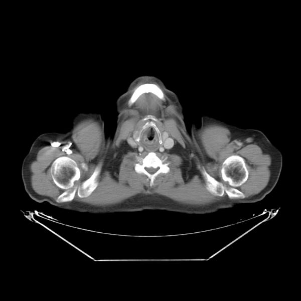File:Bronchogenic carcinoma with upper lobe collapse (Radiopaedia 29297-29726 C 1).jpg