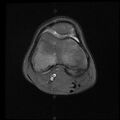 Bucket handle tear - lateral meniscus (Radiopaedia 72124-82634 Axial PD fat sat 5).jpg