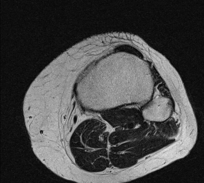 File:Bucket handle tear - medial meniscus (Radiopaedia 79028-91942 Axial T2 2).jpg