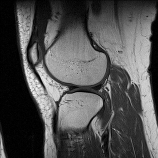 File:Bucket handle tear - medial meniscus (Radiopaedia 79028-91942 Sagittal T1 6).jpg